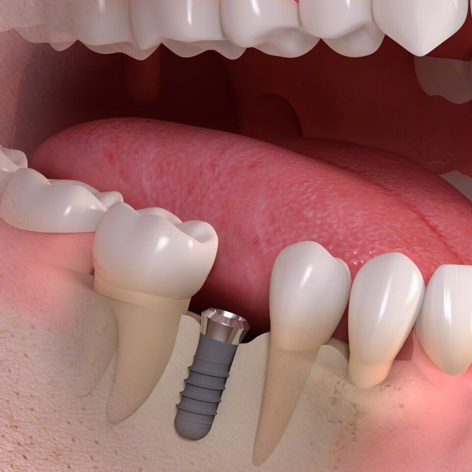 ošetření zubním implantátem
