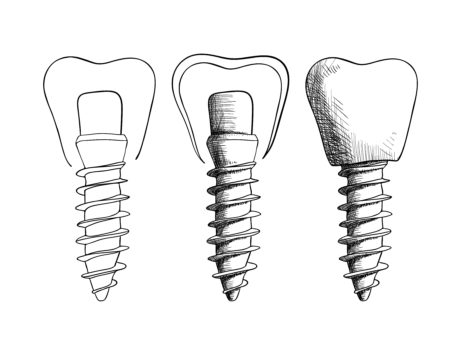 zubní implantáty blog